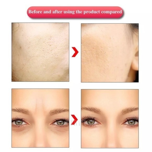 Electric microneedle - Picture 4 of 7